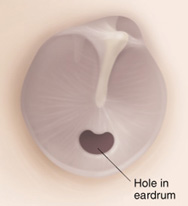 Hole in Eardrum