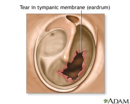 Torn Eardrum