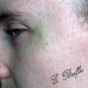 My eye is bruised, not entirely sure why. We think they had something there to protect my eye.