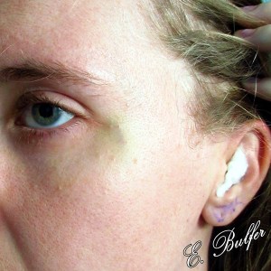 My ear is swollen (only one day after surgery)