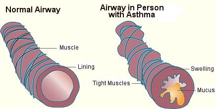 asthma-airways