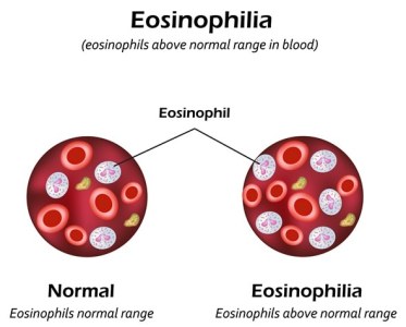 Eosinophilia