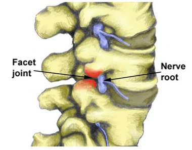 facet-joint-from-sports-clinic
