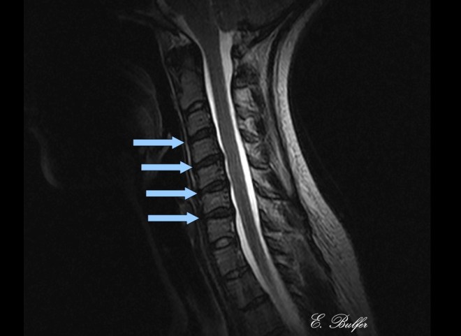 Upright Cervical MRI dessication showed signed